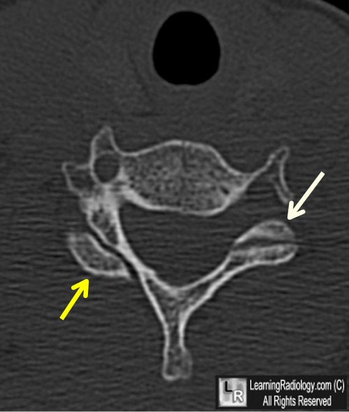 unilateral locked facet